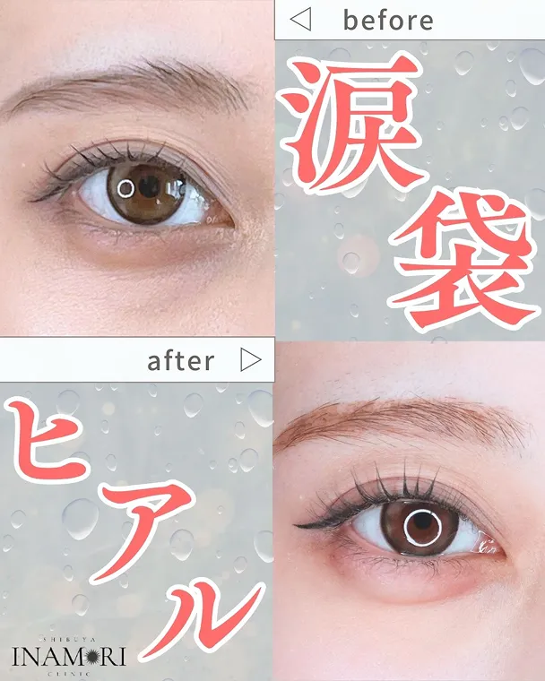 涙袋ヒアル