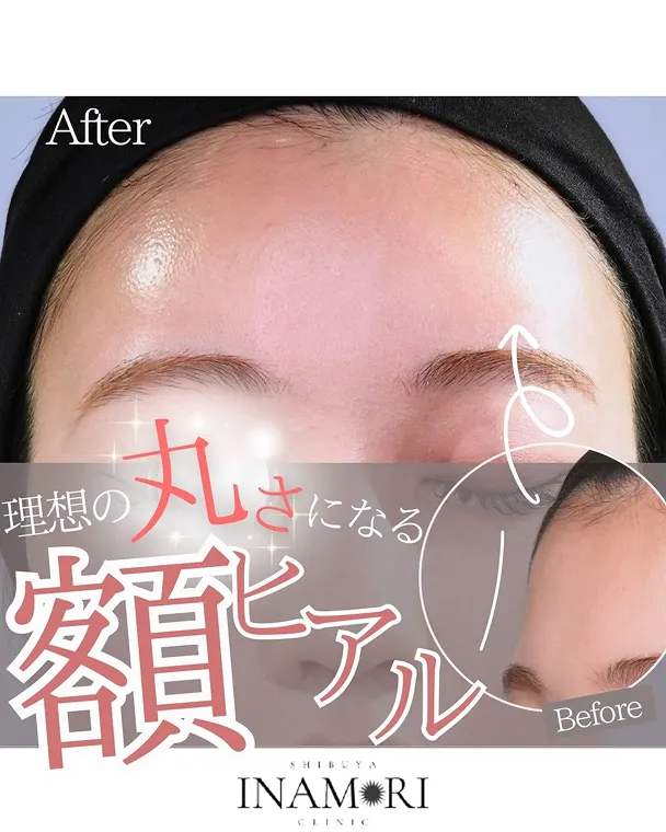理想の丸さになる額ヒアル